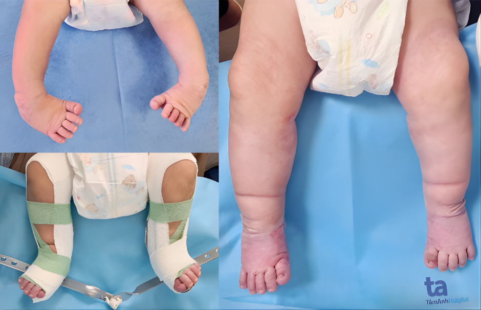 Bàn chân khoèo bẩm sinh